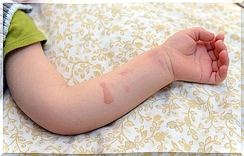 Hot water burn in a child